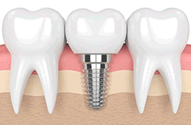 Implante dentário, Dra Lauciana Maribondo