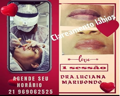 Clareamento dos lábios, em uma seção, com Dra Luciana Maribondo - ProdutosRio.com.br